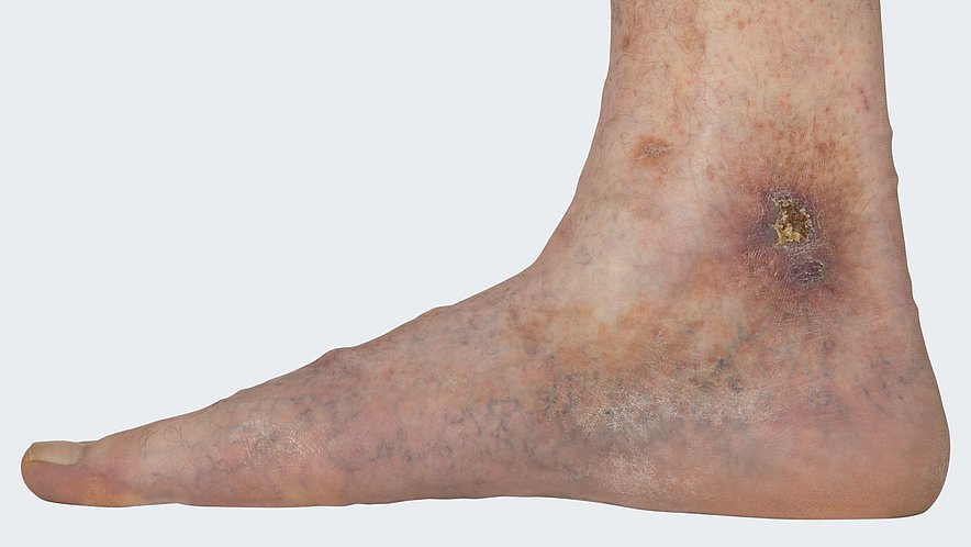C 6: Varicosis (= varicose vein disorder) with florid ulcus cruris venosum (= leg ulcer, venous-related lower leg ulcer) C 6: Varicosis (= varicose vein disorder) with florid ulcus cruris venosum (= leg ulcer, venous-related lower leg ulcer)