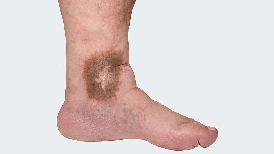 C 4: Varicosis (= varicose vein disorder) with trophic skin changes C 4: Varicosis (= varicose vein disorder) with trophic skin changes