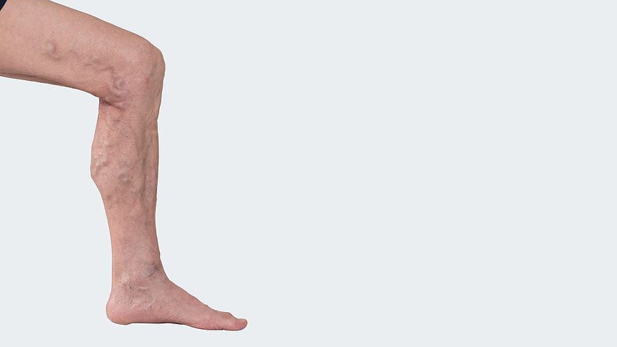 C 2: Varicosis (= varicose vein disorder) without clinical indication of a chronic venous insufficiency C 2: Varicosis (= varicose vein disorder) without clinical indication of a chronic venous insufficiency