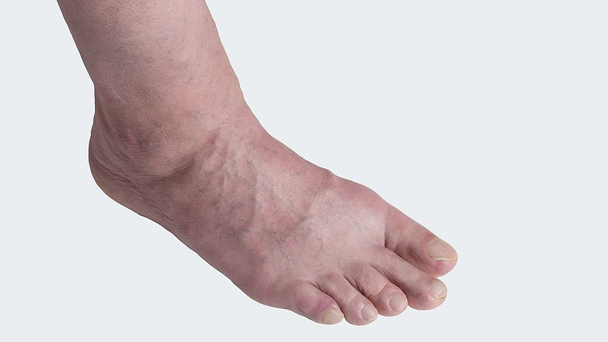C 3:Varicosis (= varicose vein disorder) with oedema (= swelling) C 3:Varicosis (= varicose vein disorder) with oedema (= swelling)