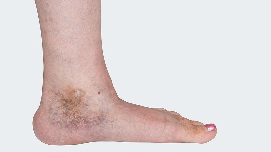 C 5: Varicosis (= varicose vein disorder) with healed ulcus cruris venosum (= leg ulcer, venous-related lower leg ulcer) C 5: Varicosis (= varicose vein disorder) with healed ulcus cruris venosum (= leg ulcer, venous-related lower leg ulcer)