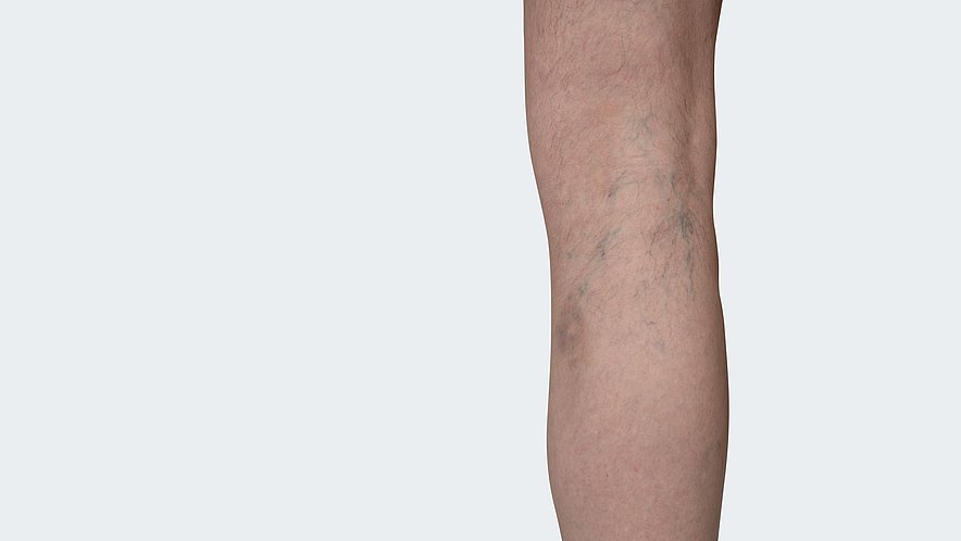 C 1: Telangiectasias (spider veins) C 1: Telangiectasias (spider veins)