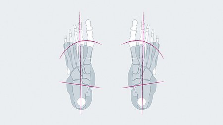 igli Carbon-Einlagen unterstützen Läufer mit Knie- oder Achillessehnenbeschwerden igli Carbon-Einlagen unterstützen Läufer mit Knie- oder Achillessehnenbeschwerden - igli Carbon-Einlagen unterstützen Läufer mit Knie- oder Achillessehnenbeschwerden