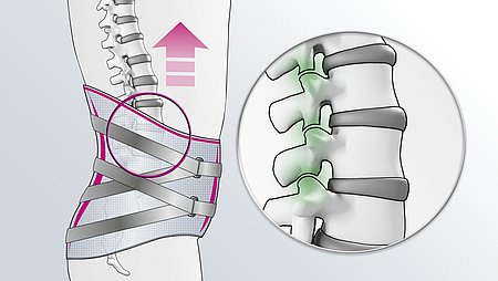 Lumbamed facet Rückenorthese Aufrichtung Entlastung der Facettengelenke durch Lumbamed facet Rückenorthese - Lumbamed facet Rückenorthese Aufrichtung