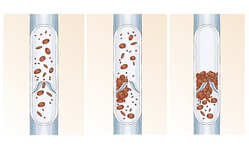Thrombose Thrombose - Thrombose