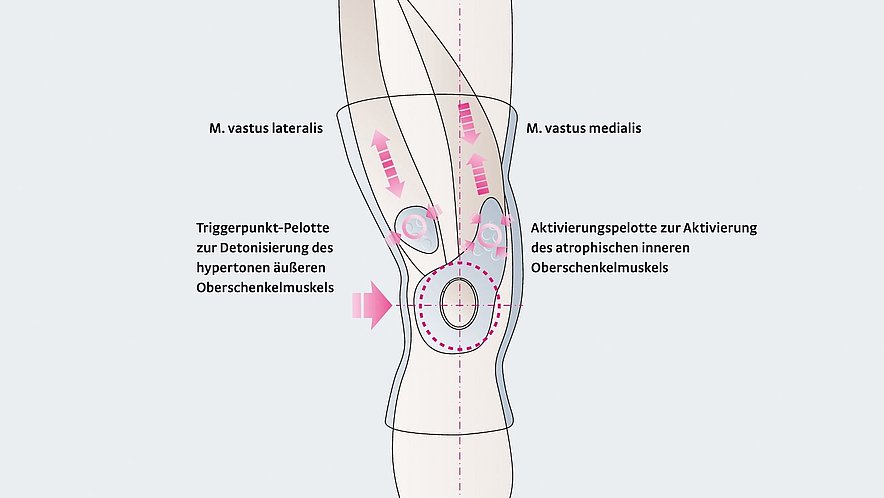 Genumedi PT Wirkungsweise Wirkungsweise der Kniebandage Genumedi PT - Genumedi PT Wirkungsweise