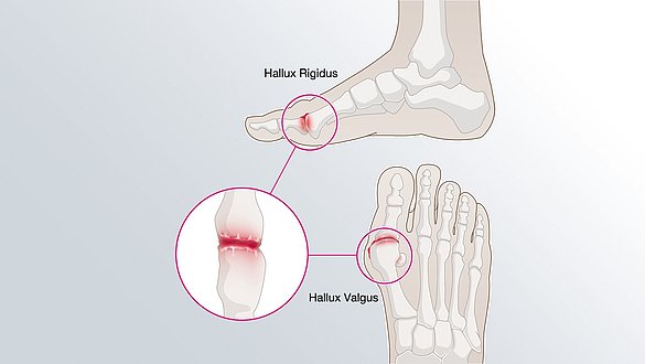 Was ist ein Hallux Valgus und wie behandelt man ihn? | medi Hallux valgus: Fußfehlstellungen wegen falscher Schuhe WELT