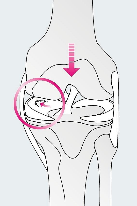 Meniskusverletzungen: Arten, Ursachen, Therapie | Medi
