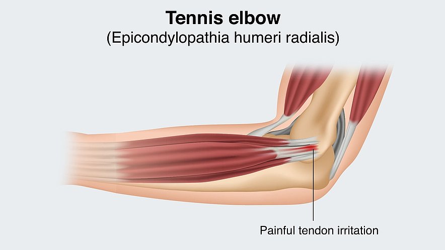 What Is Tennis Elbow   Golfer’s Elbow? 