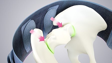 Lumbamed sacro, an orthosis for the stabilisation and stress relief of the pelvis as well as the sacroiliac joints. Lumbamed sacro, an orthosis for the stabilisation and stress relief of the pelvis as well as the sacroiliac joints. - Lumbamed sacro, an orthosis for the stabilisation and stress relief of the pelvis as well as the sacroiliac joints.