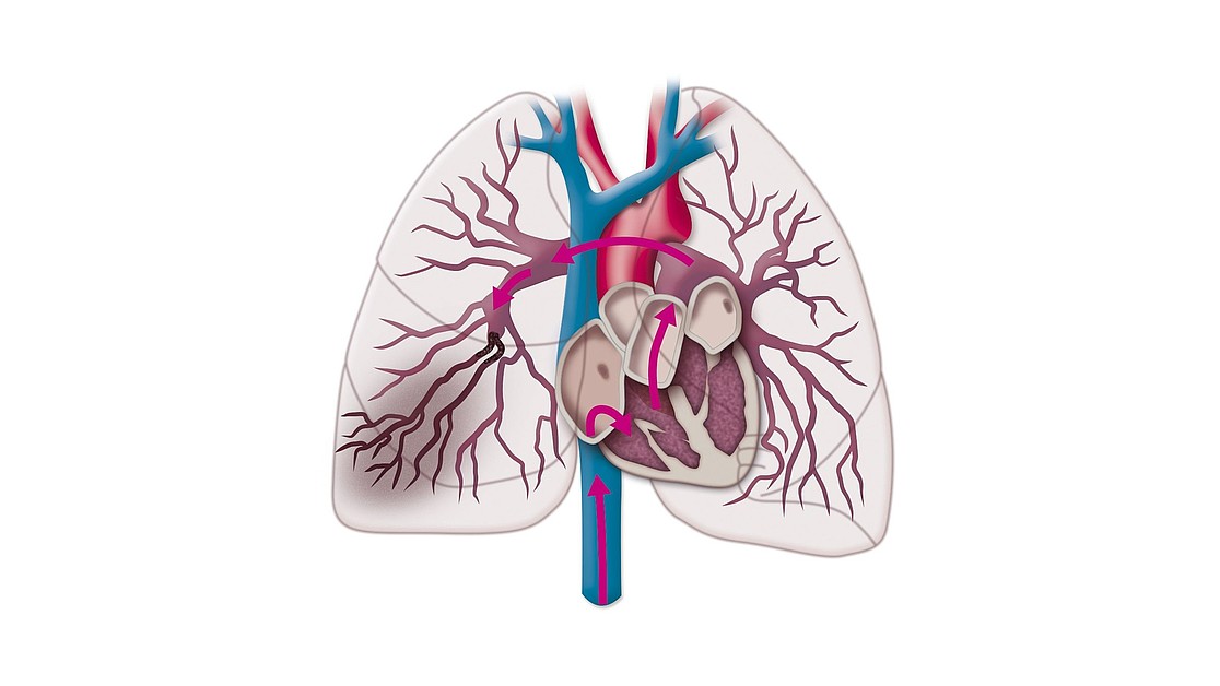 Pulmonary Embolism Origin Diagnosis And Treatment Medi
