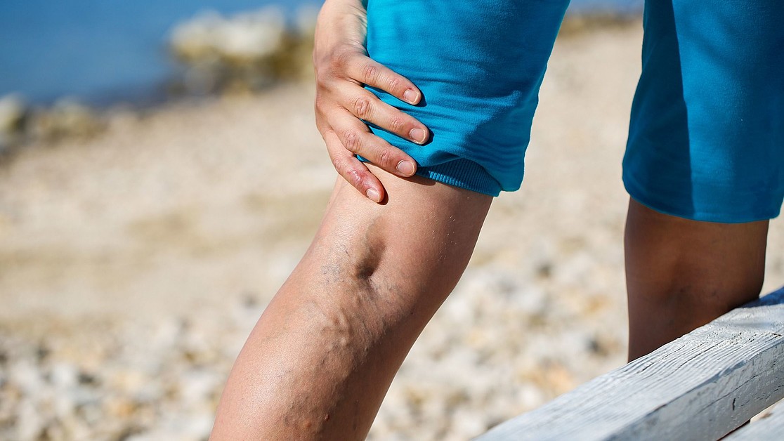 What can be done about varicose veins (varices, varicosis)?