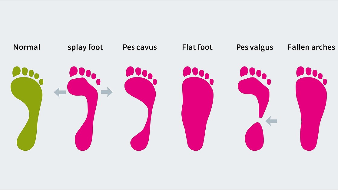 types of foot arches