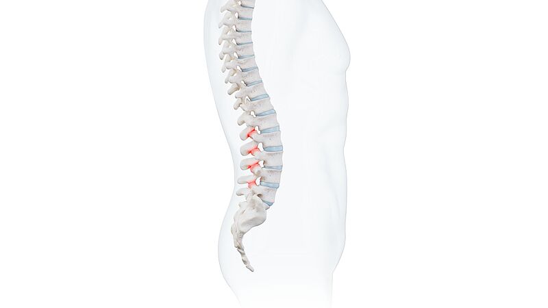 Facet joint osteoarthritis: wear and tear of the spinal joints